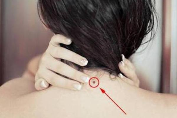 脖颈上的秘密：病痣背后的惊人真相